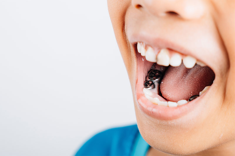 children's dentist crown procedure for kids at Masonboro Kids Dentistry Wilmington NC