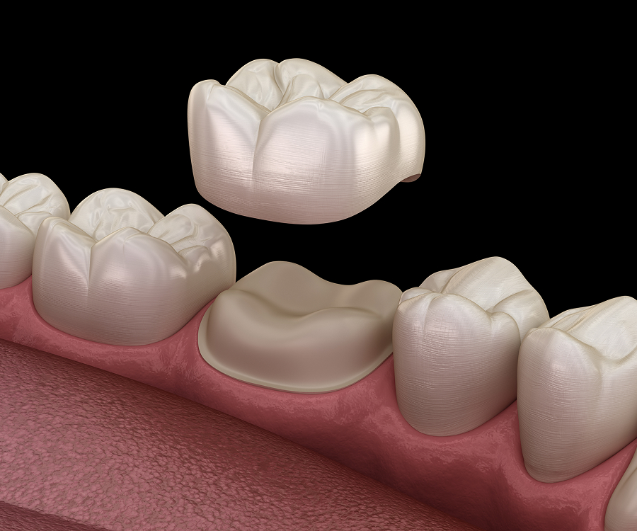 Child receiving a dental crown at Masonboro Kids Dentistry in Wilmington