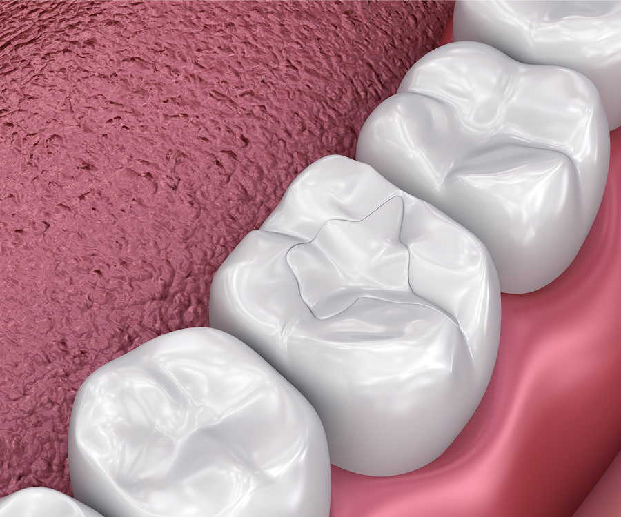 children's dentist cavity filling procedure at Masonboro Kids Dentistry in Wilmington