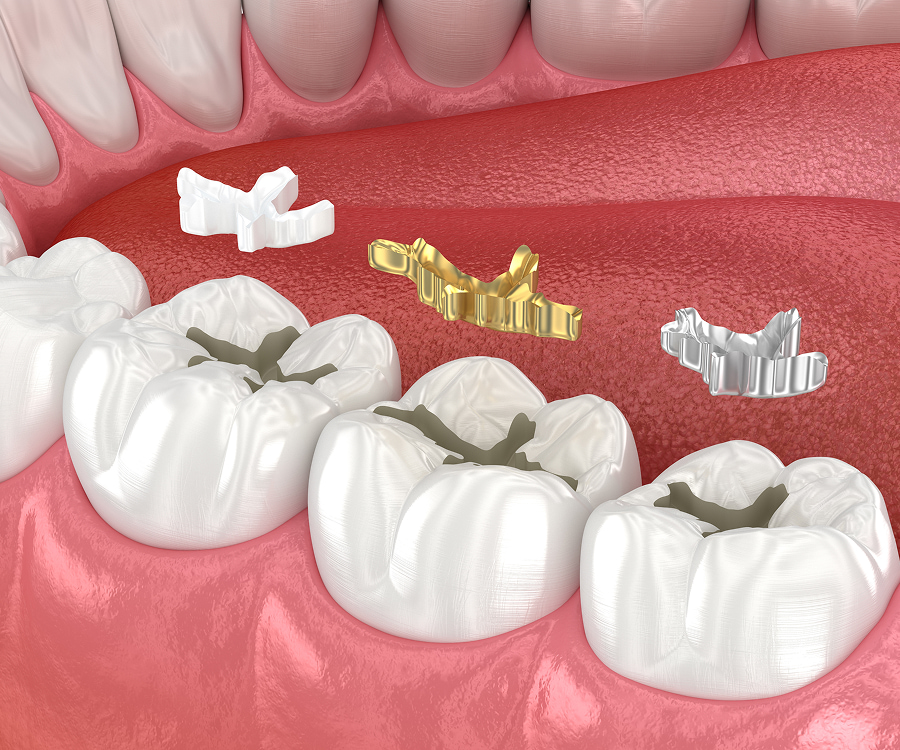 Children's Dentist applying protective sealants on child's teeth in Wilmington
