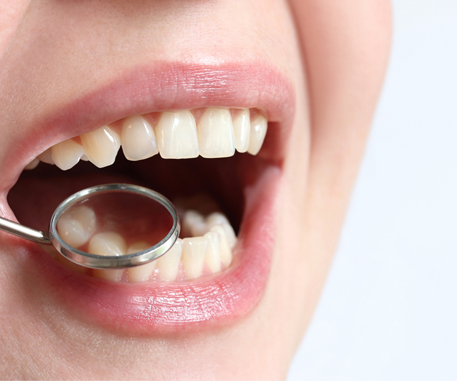 Kids dental sealants for cavity prevention at Masonboro Kids Dentistry