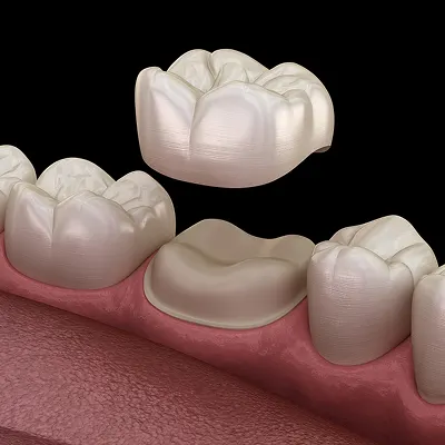 Dental Crowns – Masonboro Kids Dentistry