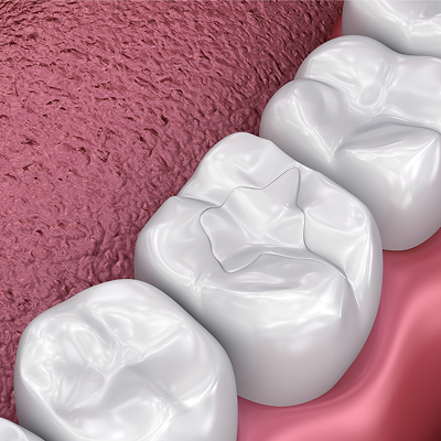 Dental Fillings – Masonboro Kids Dentistry