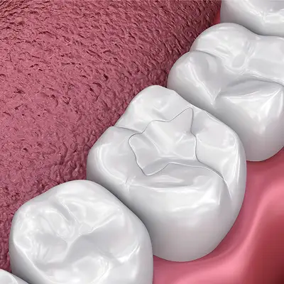 Dental Fillings – Masonboro Kids Dentistry