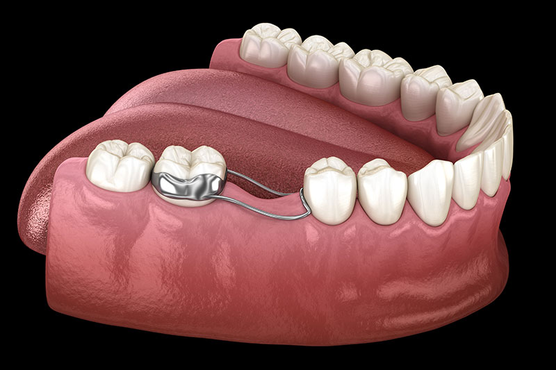 children's dentist space maintainer appliance for children at Masonboro Kids Dentistry Wilmington NC