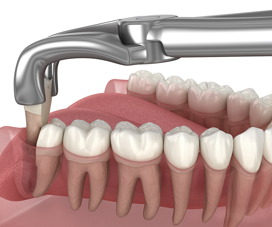 Safe and comfortable kids tooth extraction at Masonboro Kids Dentistry